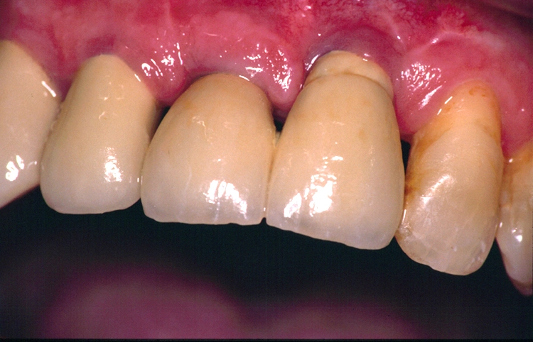 Abb. 1: Implantate bei 11 und 21. Ästhetischer Misserfolg bei 21.