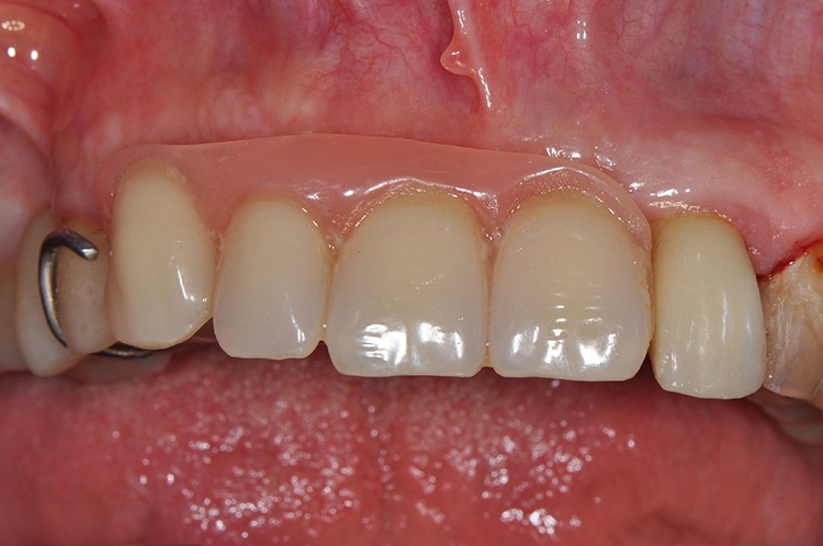 Abb. 1: Ausgangssituation: Interimsprothese.
