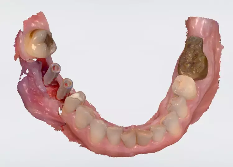 Intraopscan: Mittels eines intraoperativen Scans lassen sich die Implantate einfach
in die Planung zurücklesen und die Soll- mit der Ist-Position vergleichen.