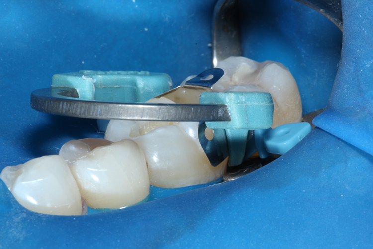 Das aufeinander abgestimmte Matrizensystem ist intuitiv zu applizieren: Die Nickel-Titan-Ringe mit glasfaserverstärkten V-förmigen Füßchen sind kompatibel mit den
selbstführenden Keilen. Die natürlich konturierten Keile komprimieren sich beim Einbringen – für zuverlässige Versiegelung mit minimalem Verletzungsrisiko des
Weichgewebes.