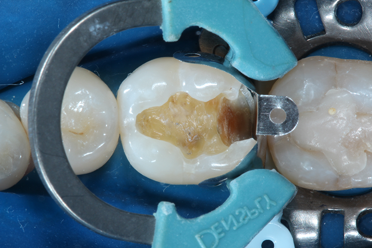 Das aufeinander abgestimmte Matrizensystem ist intuitiv zu applizieren: Die Nickel-Titan-Ringe mit glasfaserverstärkten V-förmigen Füßchen sind kompatibel mit den
selbstführenden Keilen. Die natürlich konturierten Keile komprimieren sich beim Einbringen – für zuverlässige Versiegelung mit minimalem Verletzungsrisiko des
Weichgewebes.