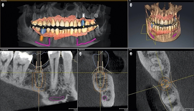 Abb. 1c: 3D-Implantatplanungssoftware.