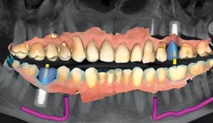 Implantatplanung – vorausgedacht.