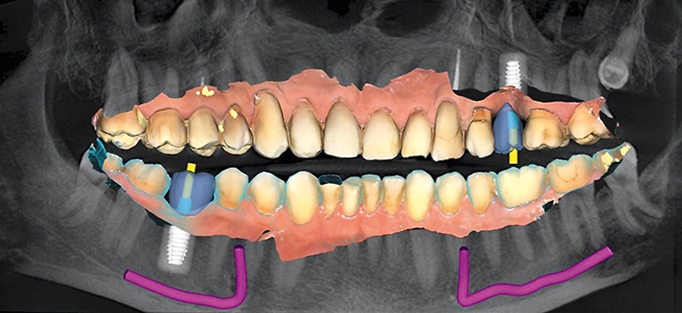 Implantatplanung – vorausgedacht.