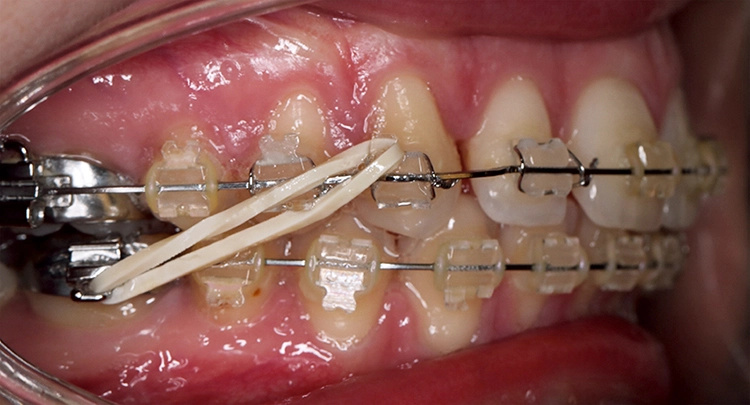 Abb. 1i: Verbesserung der sagittalen Okklusionsbeziehung mit Klasse-II-Elastics 4,2 oz Bögen: 0,016 x 0,022“ Stahl.