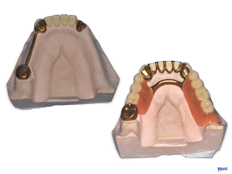 Abb. 1: Phantomarbeit des Autors aus 1983: Teleskopprothese mit Steg und Krallenschiene aus Phantomgold.