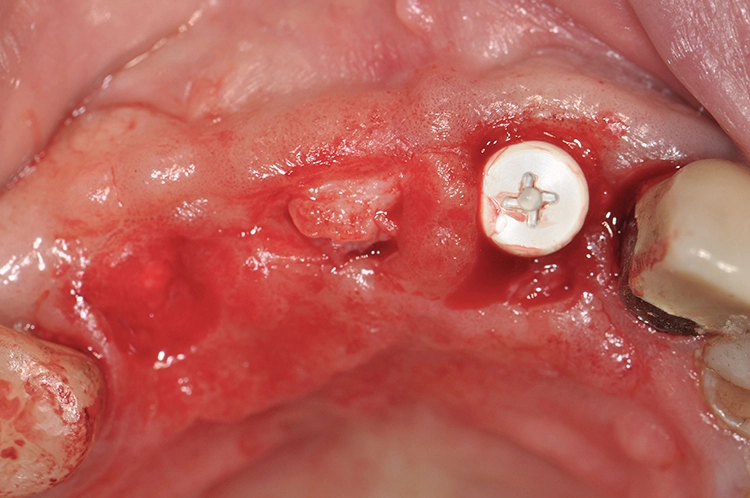 Abb. 21: Wiedereröffnung mit buccal gestieltem Bogenlappen.
