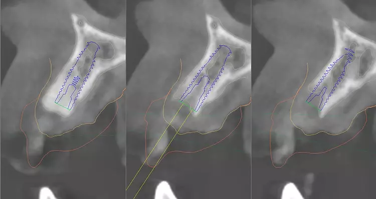 Abb. 2: Dreidimensionale Implantatplanung in einer Implantatplanungssoftware.