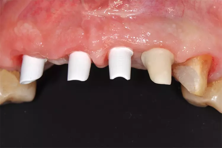 Abb. 2: Zahnachsengerechte Abutments aus Zirkonoxid (3Y-TZP), individuell ausge-schliffen und mit Implantaten verschraubt.