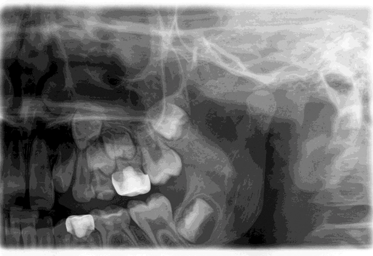 Abb. 2: Ausgangssituation: Der OPG-Ausschnitt zeigt eine koronale Aufhellung distal mit Sekundärkaries an Zahn 64 bei noch vorhandener mesialer Wurzel.