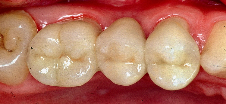 Abb. 2: Empress Glaskeramikinlays an den Zähnen 14, 15 und 16 sind als solche nicht zu erkennen.