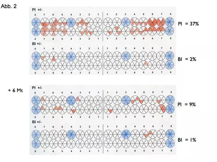 Abb. 2: Die Evaluation der Mundhygiene und des Entzündungsgrads der Gingiva
zeigte vor allem Schwierigkeiten und Optimierungspotential in den Zahnzwischenräumen.
Der Patientin wurden daher Interdentalraumbürstchen empfohlen.
Die Mundhygiene verbesserte sich deutlich im weiteren Verlauf.