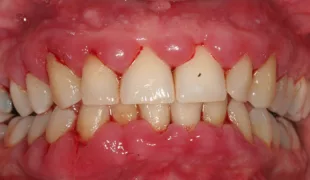 Klinisches Bild der Ausgangssituation hyperplastischer Gingiva v.a. im Frontzahnbereich des
Ober- und Unterkiefers (Mai 2022).