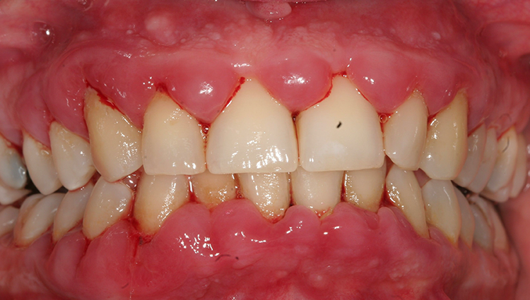 Klinisches Bild der Ausgangssituation hyperplastischer Gingiva v.a. im Frontzahnbereich des
Ober- und Unterkiefers (Mai 2022).