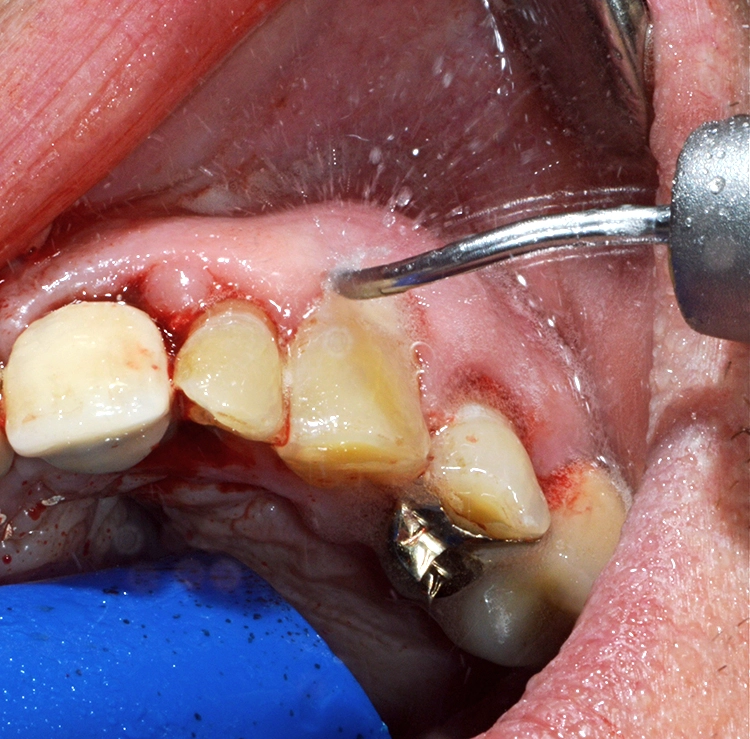 Abb. 2: Spraynebelrückprall intraoral bei Anwendung eines Schallscalers (KaVo Dental GmbH, Biberach/Riß, Deutschland) subgingival in Regio 23 im Rahmen eines Deep Scalings.