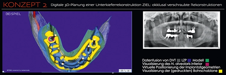 Abb. 2a: Digitale 3D-Planung einer Unterkieferrekonstruktion mit dem Ziel einer okklusal verschraubten Rekonstruktion.