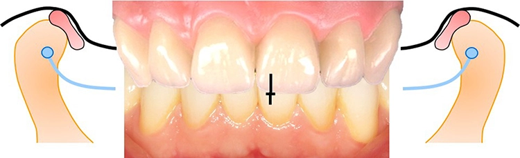 Abb. 2: Ausgehend vom Schlussbiss wird das metrische Ausmaß der Rotationsund Translationskapazität der Kondylen in den Grundbewegungen Kieferöffnung, Seitschub (Laterotrusion), Vorschub (Protrusion) und Rückzug (Retraktion) bewertet. Es kommen Lineale oder Messzirkel zum Einsatz. Hilfslinien (hier markierter Overbite auf der frontalen Verbindungslinie OK/UK) erleichtern die Bemessung des Bewegungsumfanges.
a: Schlussbisssituation mit Darstellung der physiologischen Kondylus-Diskus-Relation.