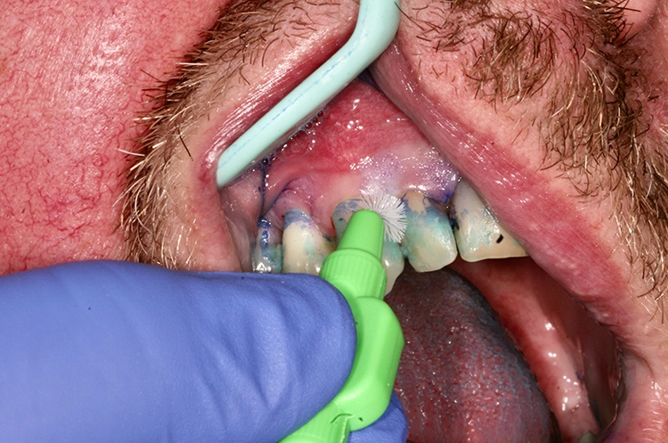 Abb. 1: Interventionen zur Instruktion und Motivation des häuslichen supragingivalen Biofilmmanagements im Rahmen einer UPT-Sitzung. Der 50-jährige Patient befindet sich im 3. Jahr nach der 2. Therapiestufe und hat ein reduziertes, aber gesundes Parodont. (b) mit individueller Anpassung größenadaptierter Interdentalraumbürsten (Tepe) zu erkennen.