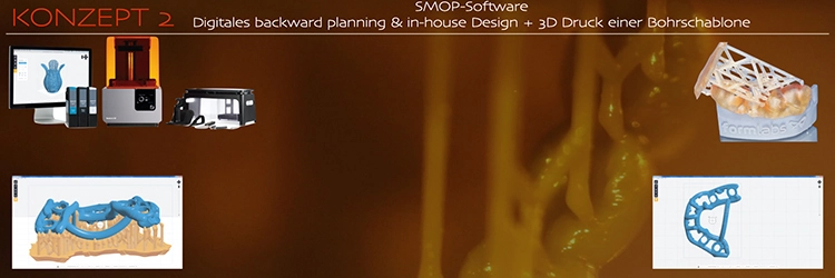 Abb. 2b: Digitales Backward-Planning & Inhouse-Design und 3D-Druck einer Bohrschablone.