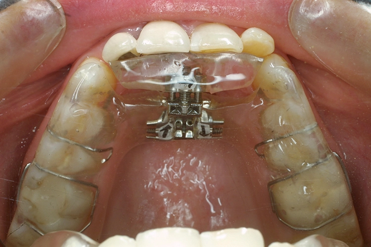 Abb. 2b: Die aktive Äquilibrierungsschiene trägt beidseits plane Aufbisse und ermöglicht mit der eingearbeiteten Bertonie-Schraube bereits von Anfang an sagittale und transversale orthodontische Korrekturen der Zahnstellung.
