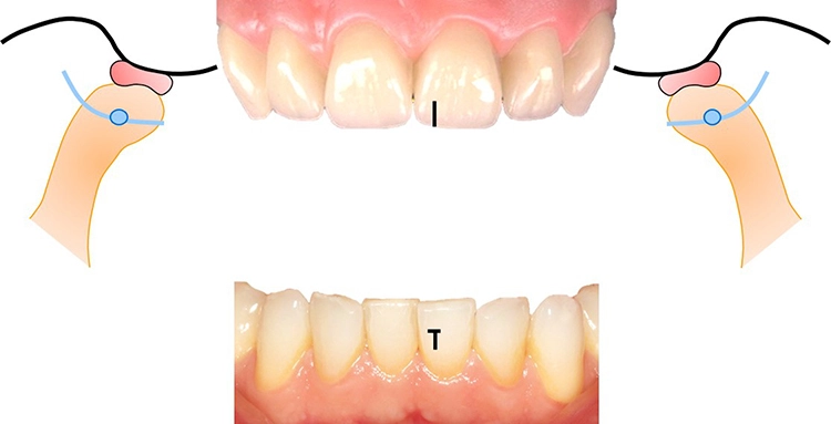 Abb. 2: Ausgehend vom Schlussbiss wird das metrische Ausmaß der Rotationsund Translationskapazität der Kondylen in den Grundbewegungen Kieferöffnung, Seitschub (Laterotrusion), Vorschub (Protrusion) und Rückzug (Retraktion) bewertet. Es kommen Lineale oder Messzirkel zum Einsatz. Hilfslinien (hier markierter Overbite auf der frontalen Verbindungslinie OK/UK) erleichtern die Bemessung des Bewegungsumfanges.
b: Subtotale Kieferöffnung mit Darstellung der translativen Kondylenposition bilateral.