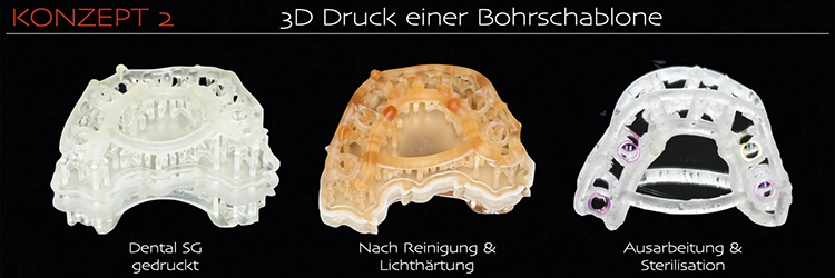 Abb. 2c: 3D-Druck einer Bohrschablone.