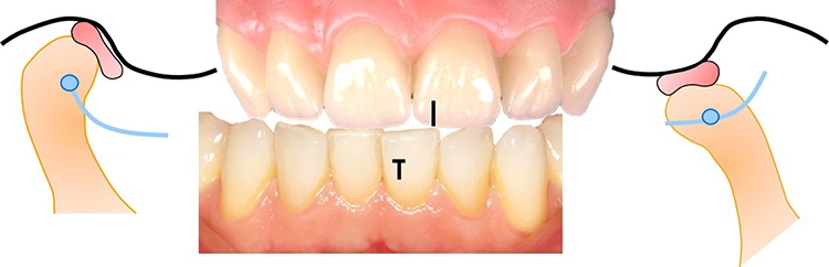 Abb. 2: Ausgehend vom Schlussbiss wird das metrische Ausmaß der Rotationsund Translationskapazität der Kondylen in den Grundbewegungen Kieferöffnung, Seitschub (Laterotrusion), Vorschub (Protrusion) und Rückzug (Retraktion) bewertet. Es kommen Lineale oder Messzirkel zum Einsatz. Hilfslinien (hier markierter Overbite auf der frontalen Verbindungslinie OK/UK) erleichtern die Bemessung des Bewegungsumfanges.
c: Laterotrusion nach rechts mit Darstellung des unilateralen Transversalschubs des linken Kondylus