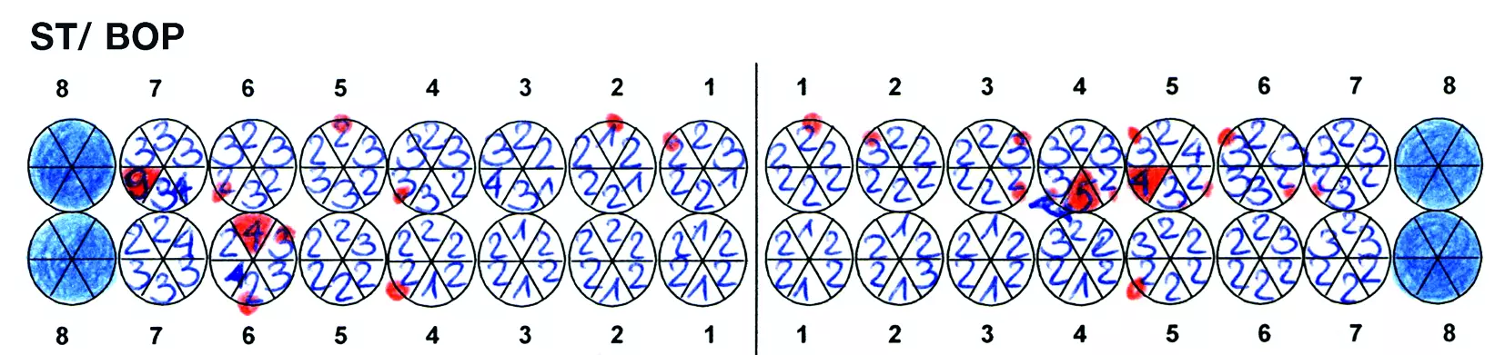Abb. 2d: ... Nach jahrelangem Scaling und Root Planing sowie der Benutzung von Interdentalbürsten sind stark sanduhrförmige Zahnhälse entstanden (intraorale Aufnahmen sowie im Rahmen der UPT aufgenommener parodontaler Befund. Zur Feststellung der Behandlungsnotwendigkeit sollten die Sondierungstiefen und ggf. die Blutung auf Sondierung dreimonatlich erfasst werden).