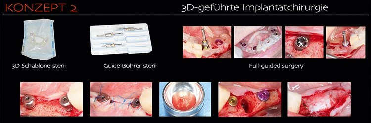Abb. 2d: Die 3D-geführte Implantatchirurgie.