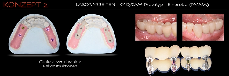 Abb. 2e: Laborarbeiten – CAD/CAM Prototyp – Einprobe (PMMA).