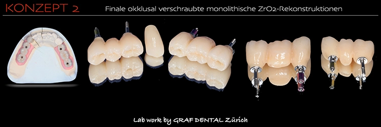 Abb. 2f: Finale, okklusal verschraubte monolithische ZrO2-Rekonstruktionen.