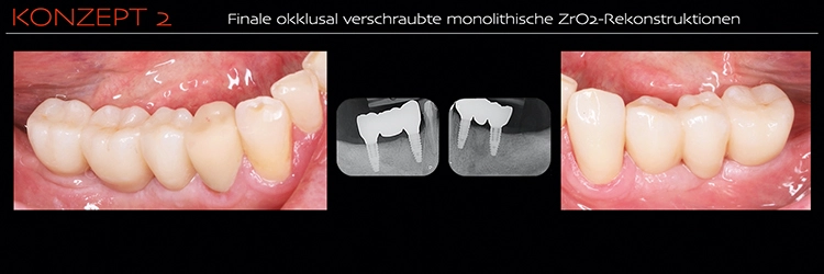 Abb. 2g: Finale, okklusal verschraubte monolithische ZrO2-Rekonstruktionen.