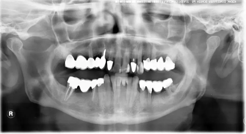 Abb. 10: Recall 2012 im Rahmen der halbjährlichen UPT nach Furkationskaries an 47 mit Füllungstherapie und endodontischer Behandlung 47...