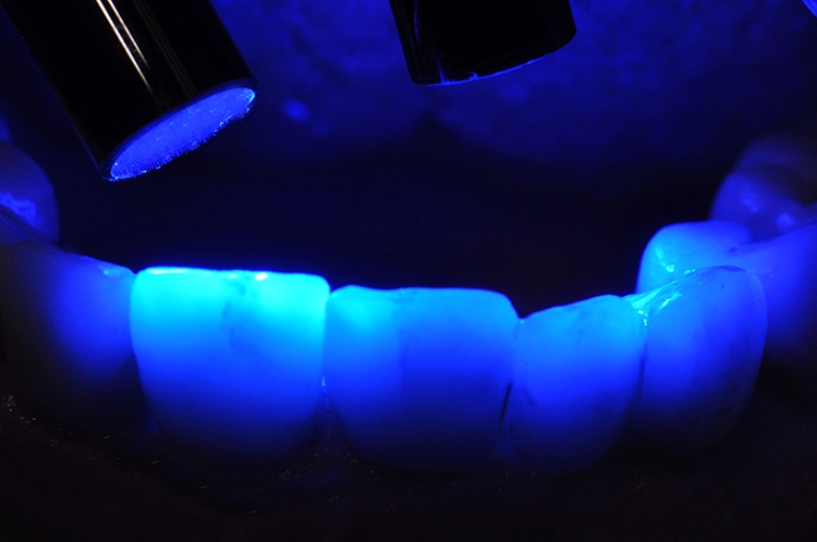Abb. 32: Intraorale spannungsfreie Verklebung von Restauration und NobelPearl-Abutments.
