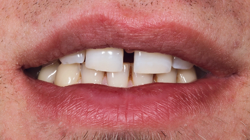 Abb. 17: Diastema mediale bei einem 20-jährigen jungen Mann.