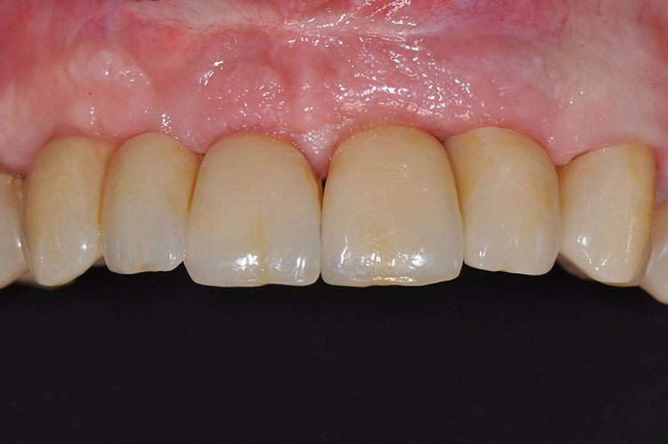 Abb. 36b: Restauration in situ – buccale Ansicht.