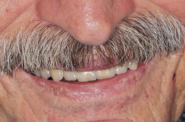 Abb. 36c: Restauration in situ – en face.