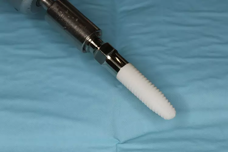 Abb. 3: Konisches Implantat aus Zirkonoxid für eine vorhersagbare hohe Primärstabilität.