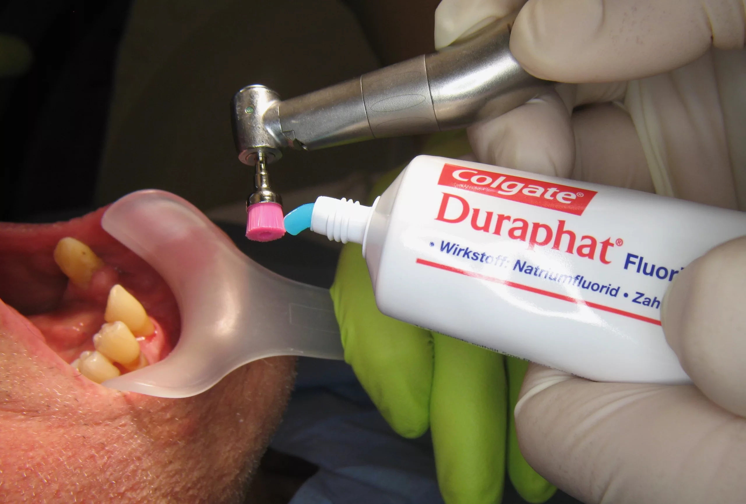 Abb. 3: Einsatz der Duraphat® Zahnpaste im Rahmen der UPT.