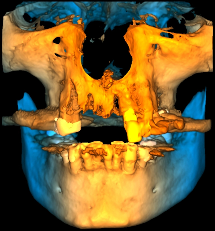 Abb. 3: Faciale Defektsituation in der Oberkiefer-Front.