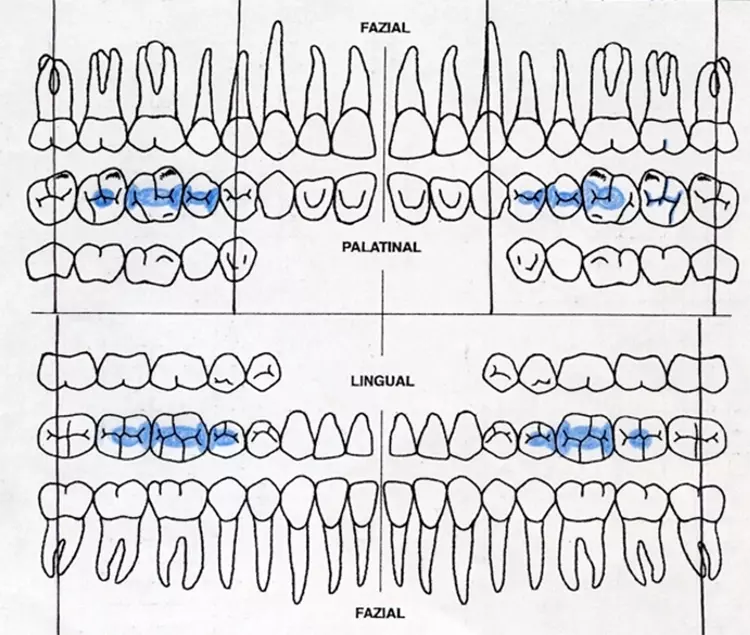 Abb. 3: Dentaler Befund: An einigen Zähnen lagen als suffi zient eingestufte Kompositrestaurationen vor.