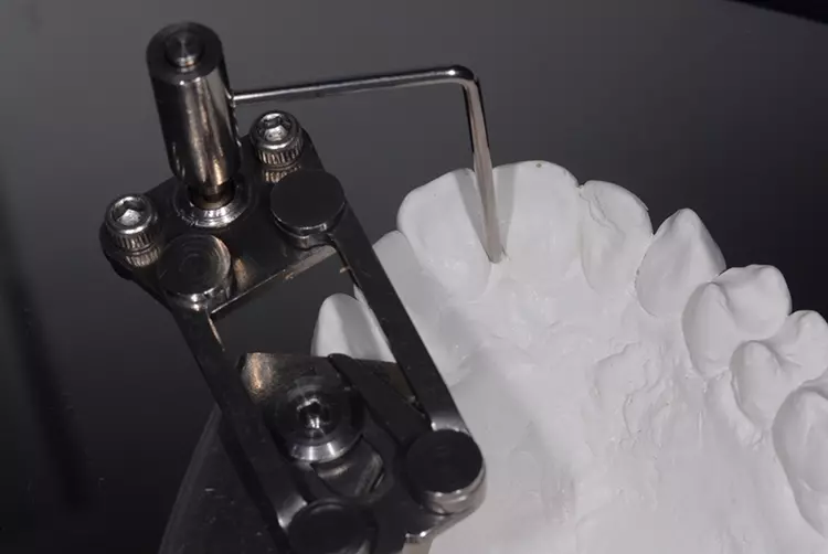 Abb. 3a: Planung einer intrakoronalen Retention
mit palatinaler Präparation mittels Parallelometer
bei einer Patientin nach parodontaler und
kieferorthopädischer Therapie.