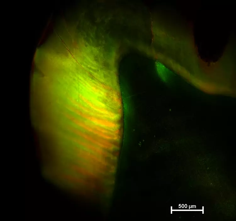 Abb. 3b: CLSM(Control Laser Scanning Microscopy)-Bild der Läsionstiefe am MIHZahn
aus Abb. 3a. Im MIH-veränderten Bereich ist das grün-gelb-orange Fluoreszenzsignal
in der gesamten Schmelzschicht zu sehen. Im Bereich des gesunden
Schmelzes ist keine Farbveränderung mit der indirekten Färbemethode zu erkennen.