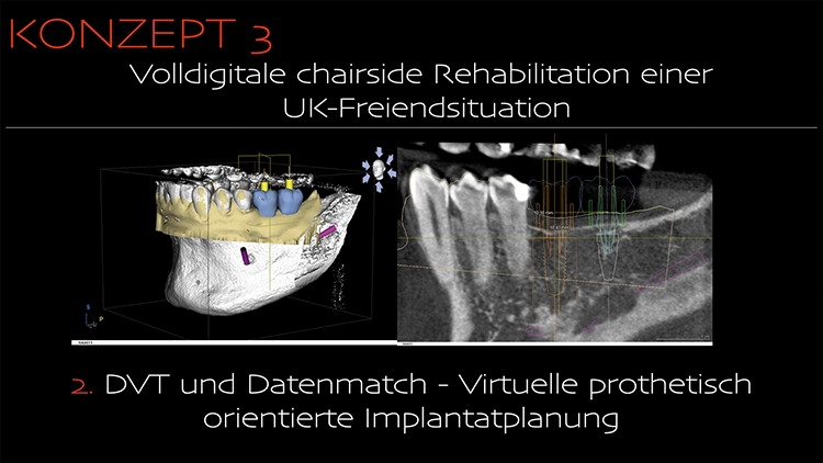 Abb. 3b: DVT und Datenmatch – virtuelle, prothetisch orientierte Implantatplanung.