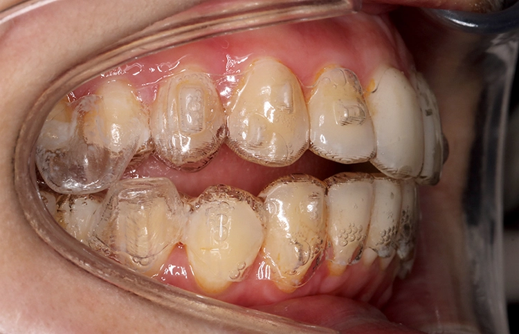 Abb. 3b: ... sowie sagittale Positionierung der Mandibula mit Mandibular Advancement Precision Wings (Invisalign).