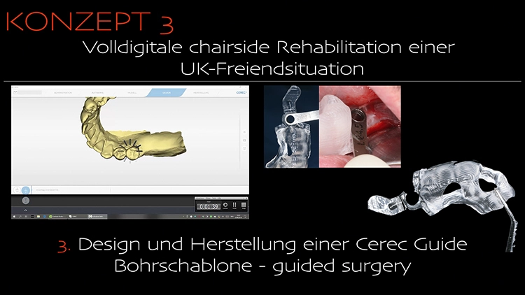 Abb. 3c: Design und Herstellung einer Cerec Guide Bohrschablone – guided surgery.