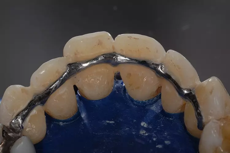 Abb. 3d: adhäsives
Zementieren mit opakem Kompositzement.