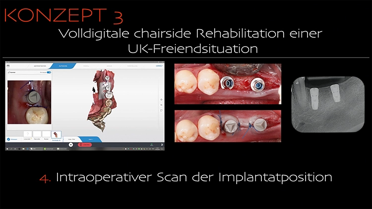 Abb. 3d: Intraoperativer Scan der Implantatposition.