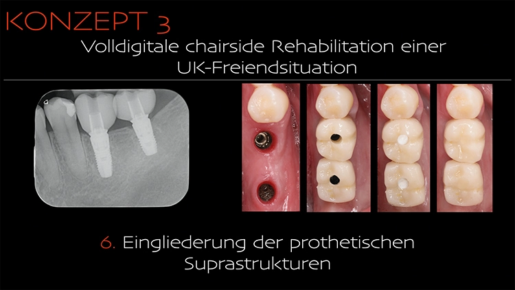 Abb. 3f: Eingliederung der prothetischen Suprastrukturen.