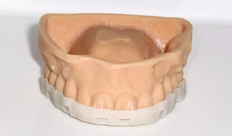 Abb. 4: OK-Positionierungsschiene für die PMMA-Langzeitprovisorien
nach vorangegangenem digitalem Wax-up.